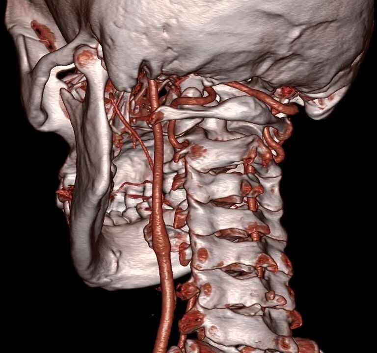 suspausta arterija su gimdos kaklelio osteochondroze