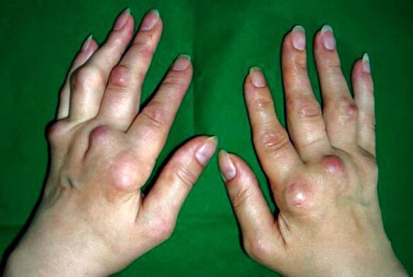 Deformuojančio poliosteoartrito pažeistos rankos