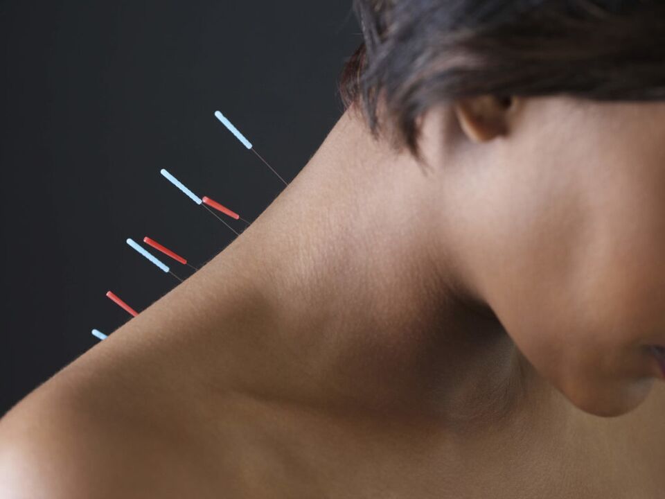 Gimdos kaklelio osteochondrozės akupunktūra pašalina uždegiminius procesus